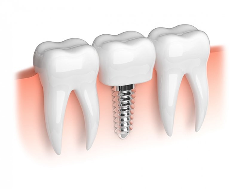 Ce avantaje importante aduce un implant dentar și de ce este considerat o soluție optimă în cazul pierderii unui dinte?