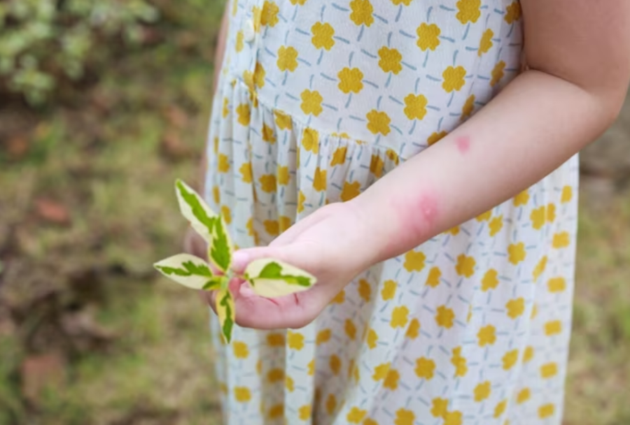 Creșterea alarmantă a cazurilor de dermatită atopică afectează din ce în ce mai mulți copii și adolescenți